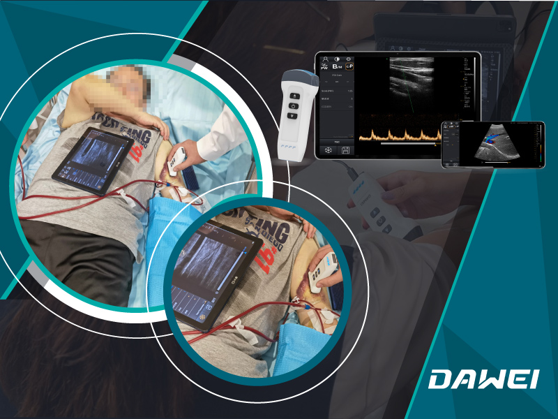 Enhancing Kidney Diagnostics The Role of Wireless Ultrasound Scanners in Nephrology-800-600.jpg